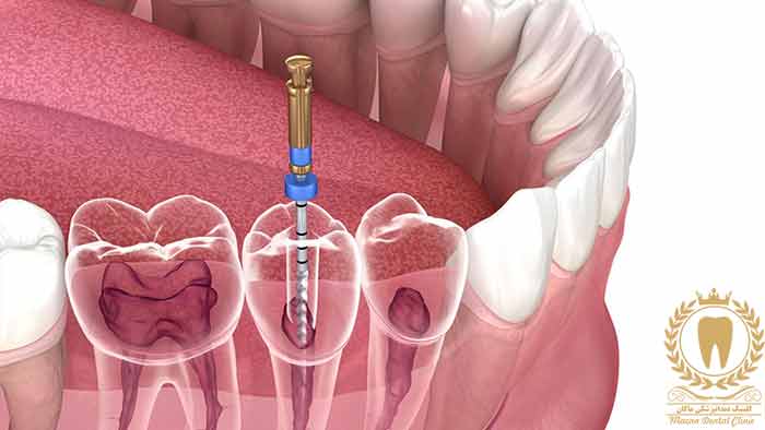 عصب کشی دندان (Root Canal)