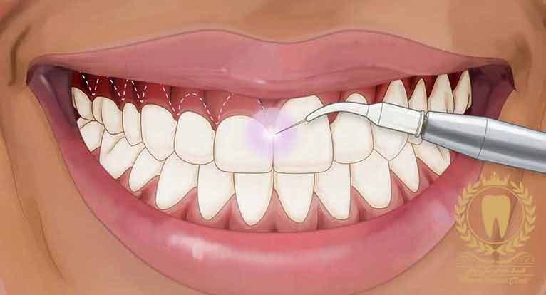 عمل جراحی لیفت لثه و کانتورینگ (افزایش طول تاج دندان)