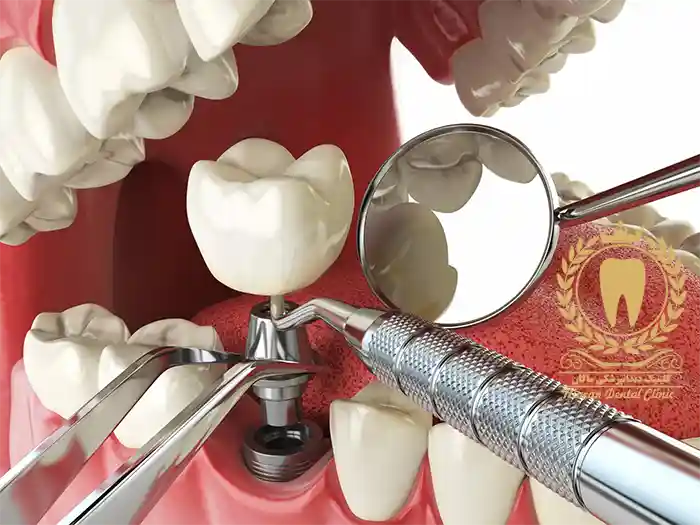 متخصص ایمپلنت دندان یا ایمپلنتولوژیست دندان کیست ؟
