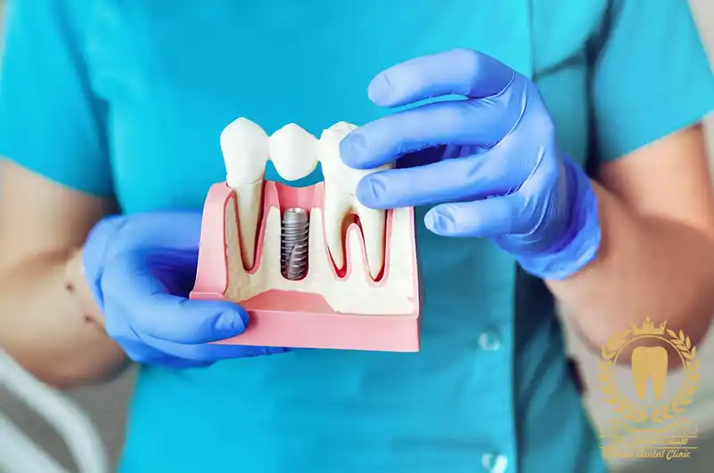 بهترین متخصص ایمپلنت دندان چه کسی است؟