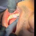 ترمیم دندان  5 خلفی با کامپوزیت آلمانی