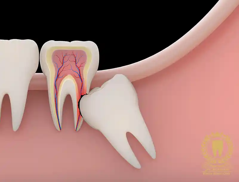 جراحی دندان عقل نهفته: راهنمای کامل برای کشیدن دندان عقل