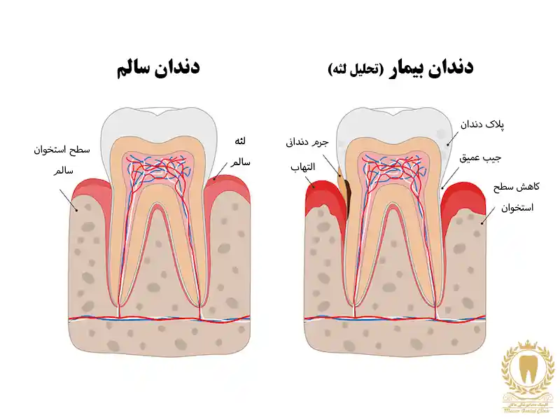 اهمیت تحلیل لثه برای حفظ بهداشت دهان و دندان