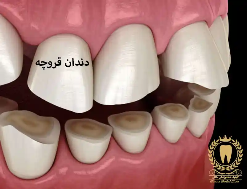 دندان قروچه چیست؟ عوارض و روش های درمان