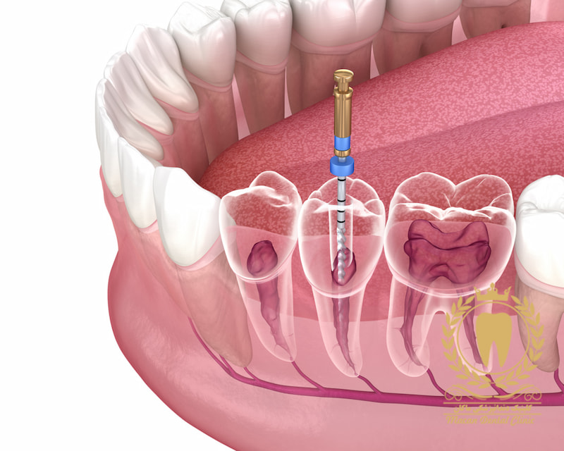 درباره عصب کشی دندان عقل بیشتر بدانید