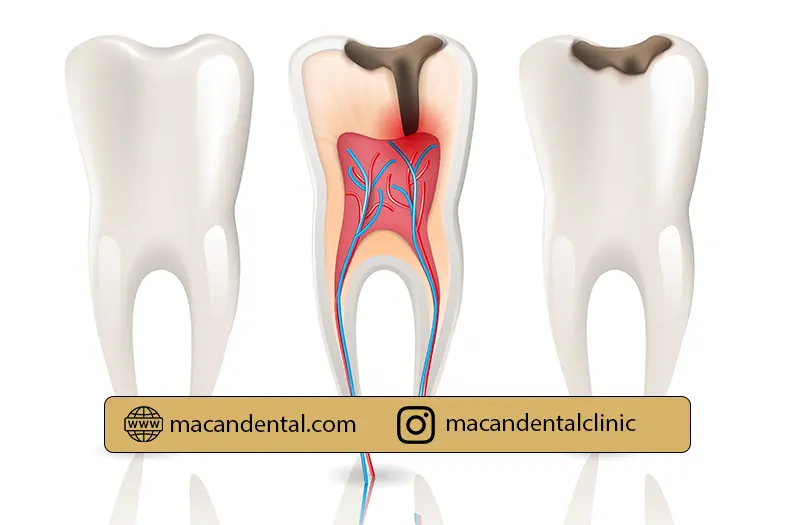 درباره عصب کشی دندان عفونت کرده بیشتر بدانید