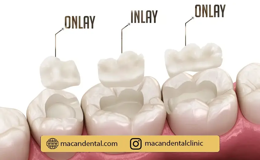ترمیم دندان با اینله و آنله : بازسازی و بهبود دندان‌های آسیب‌دیده