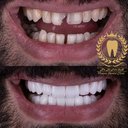 لمینت سرامیکی Ips Emax آلمانی