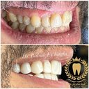 اجرای ونیر کامپوزیت Ultradent