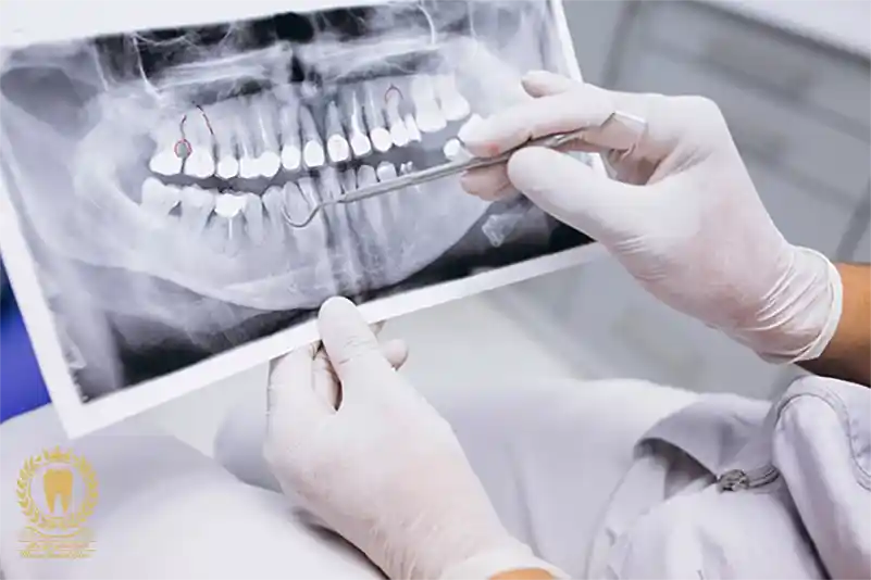 رادیولوژی دندان چیست و چگونه انجام می شود؟
