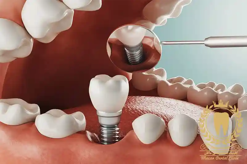 بهترین زمان ایمپلنت دندان بعد از کشیدن دندان