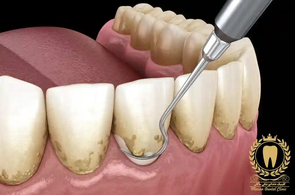 جرمگیری دندان و مدت زمان جرمگیری دندان