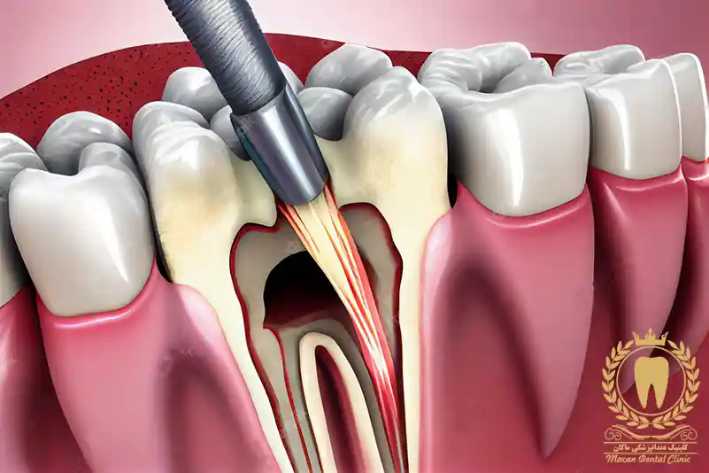 عصب کشی دندان در زعفرانیه