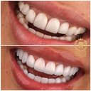 لمینت سرامیکی Emax آلمان