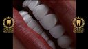 لمینت IPS Emax لبه شفاف درجه یک آلمانی